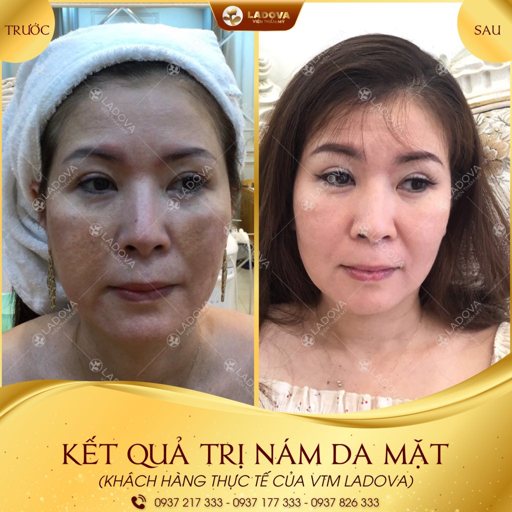 dieu-tri-nam-da-mat-01