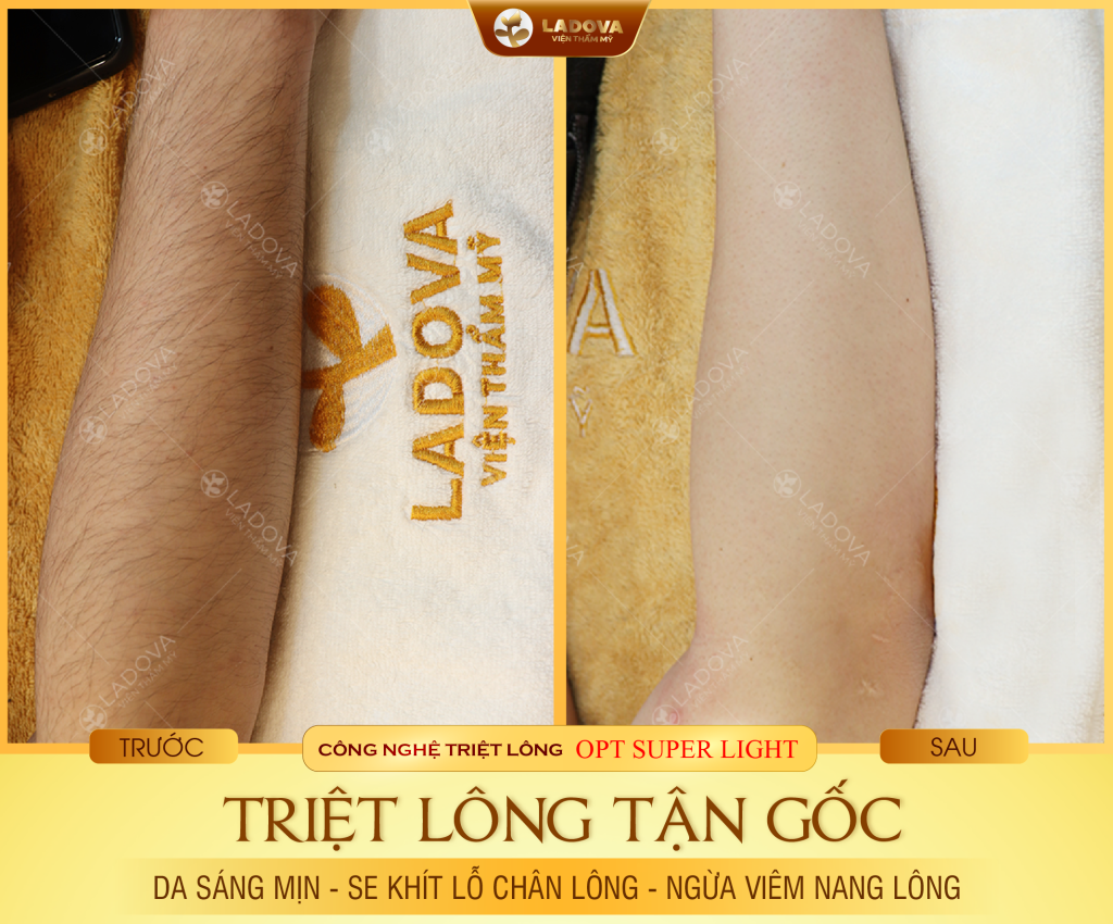 triet-long-tay-gia-re-01
