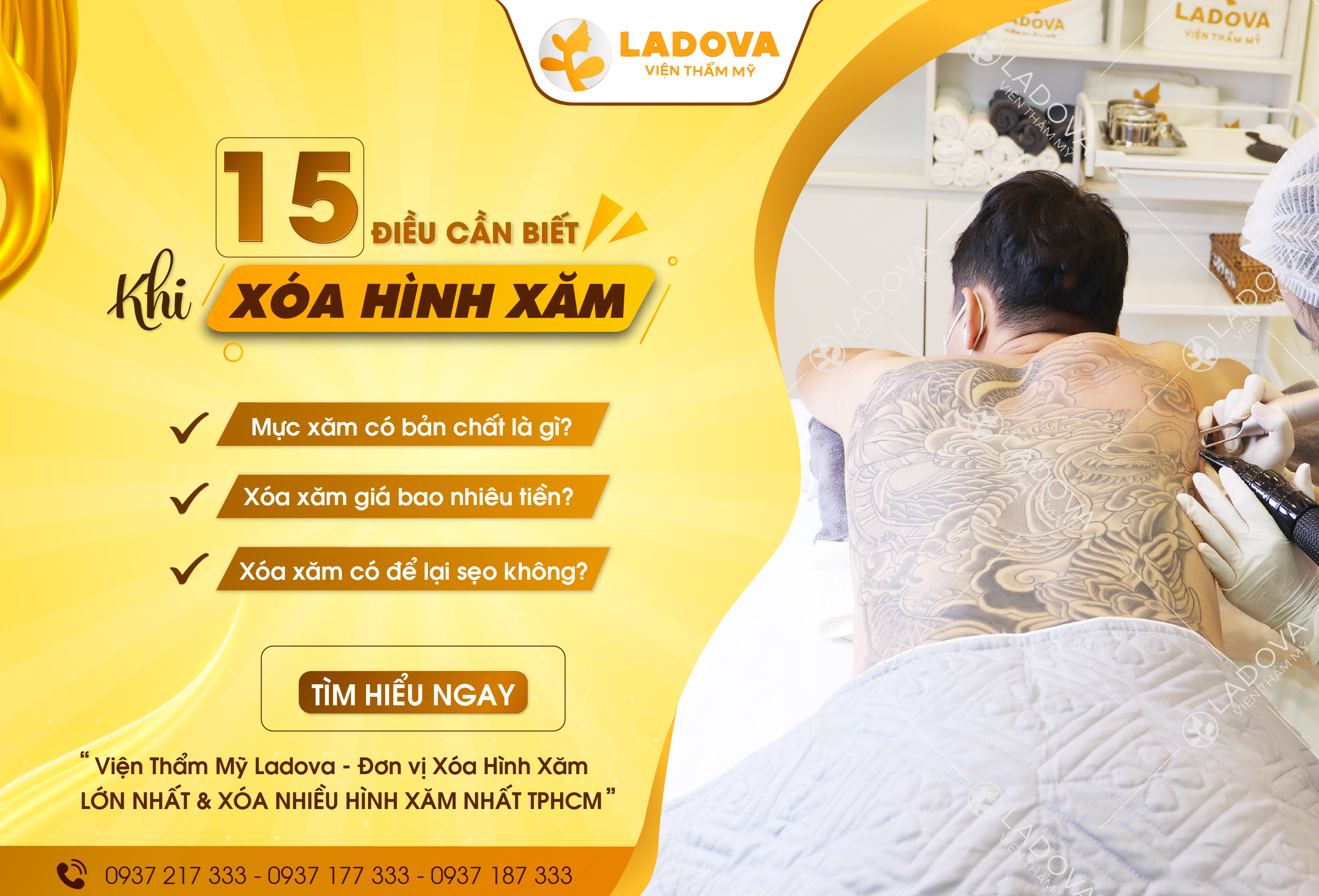 15-dieu-can-biet-khi-xoa-hinh-xam-01