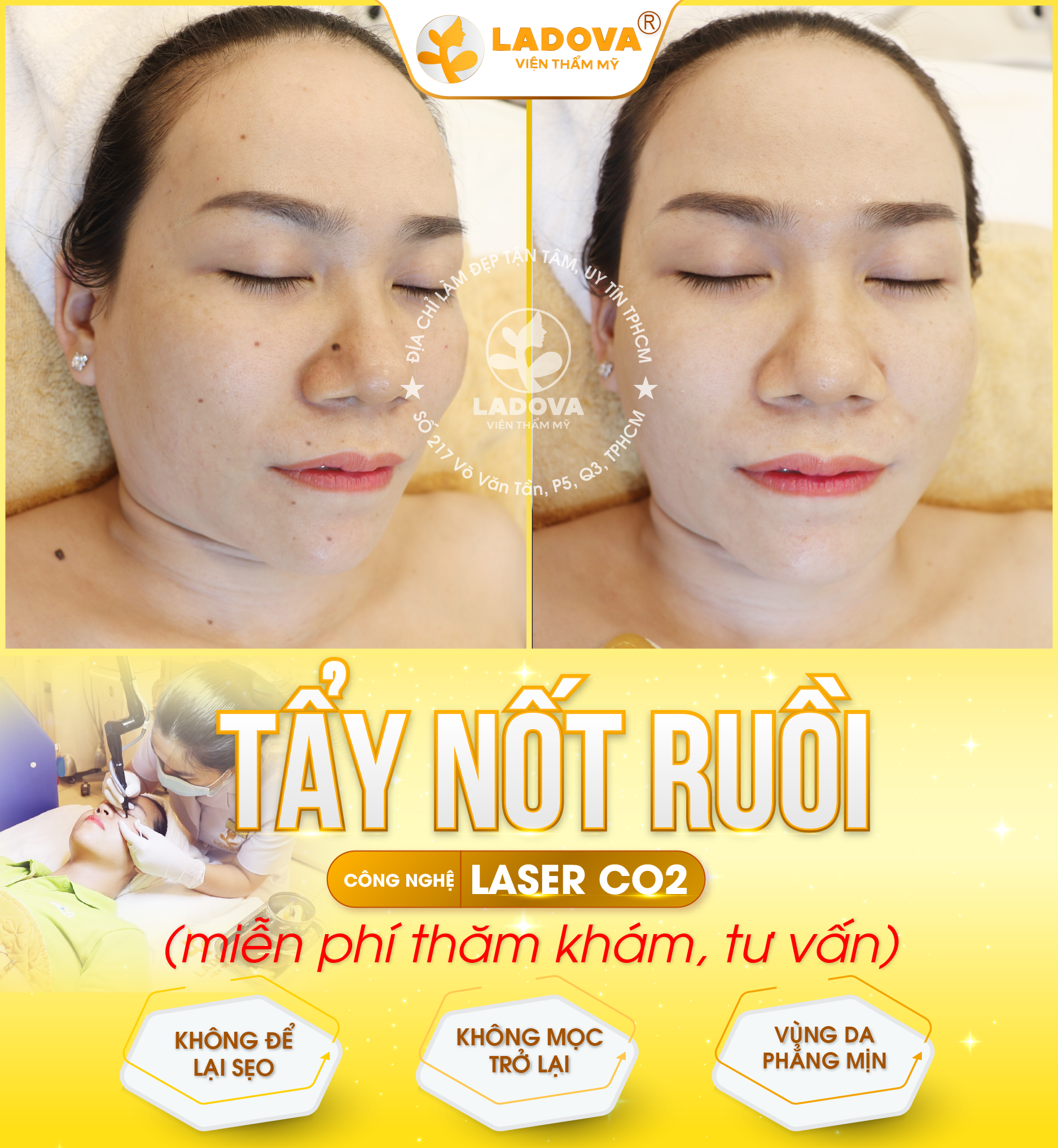 cach-tay-not-ruoi-laser-co2-01