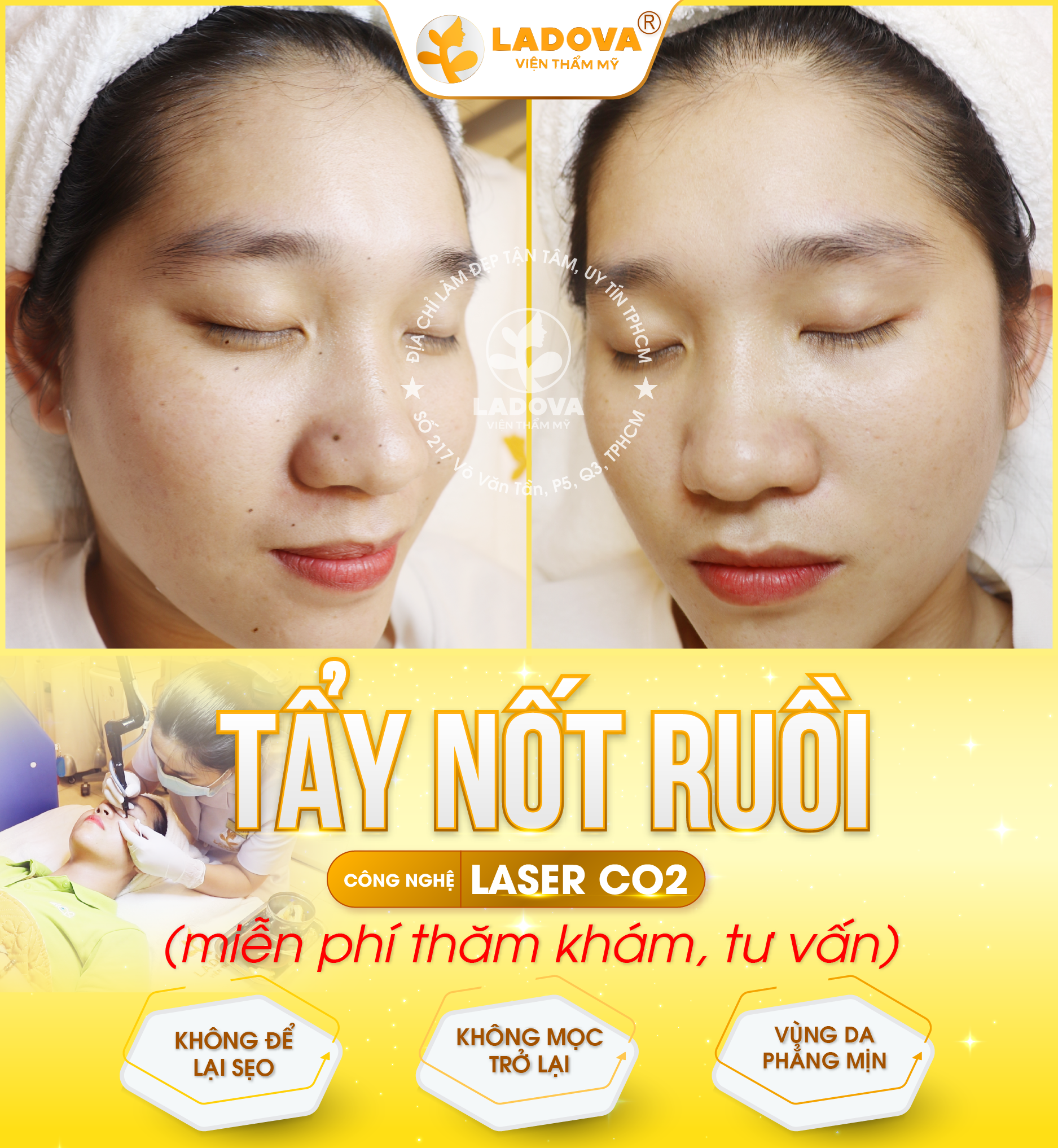 spa-tay-not-ruoi-01
