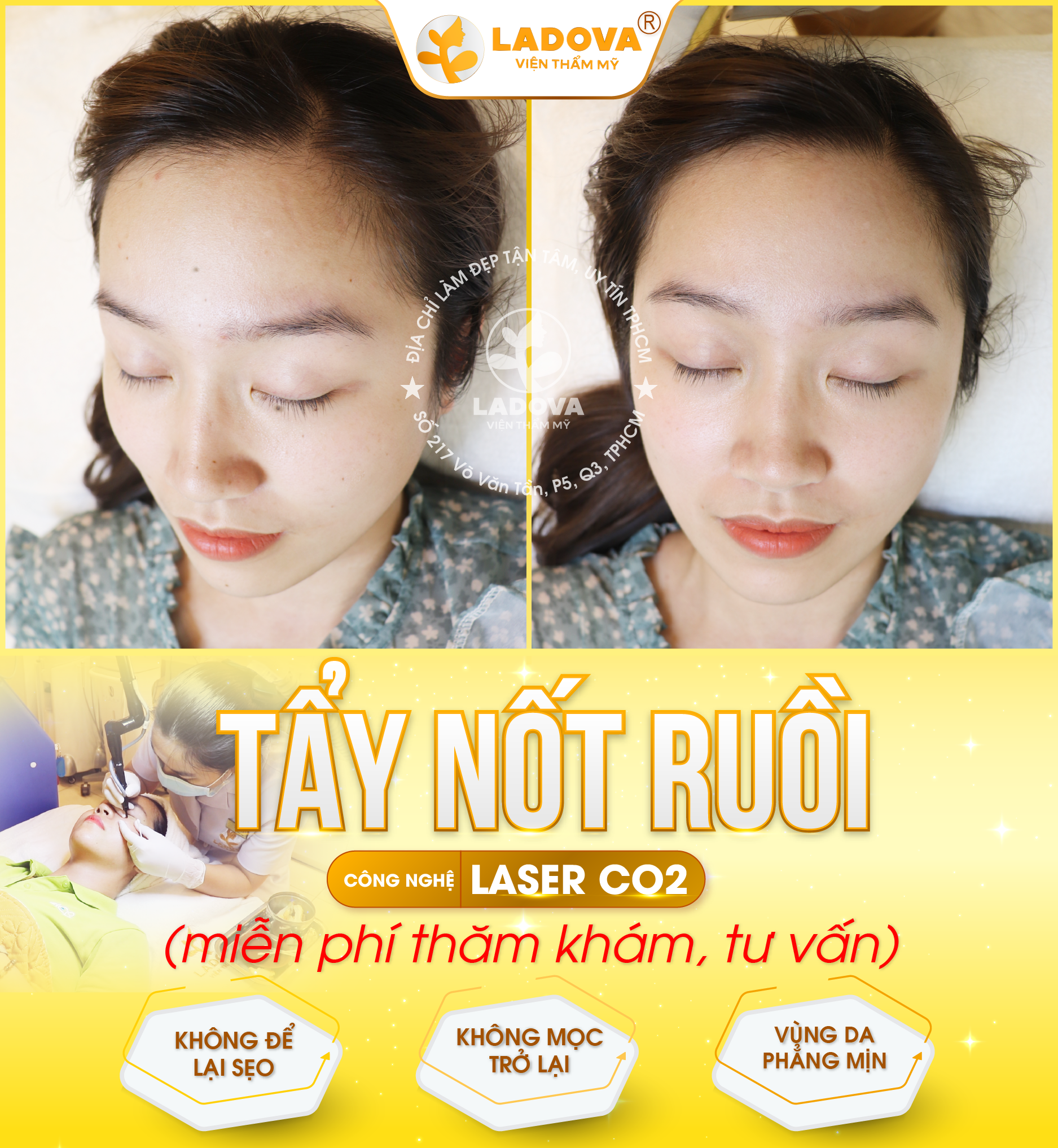 xoa-not-ruoi-hieu-qua-01